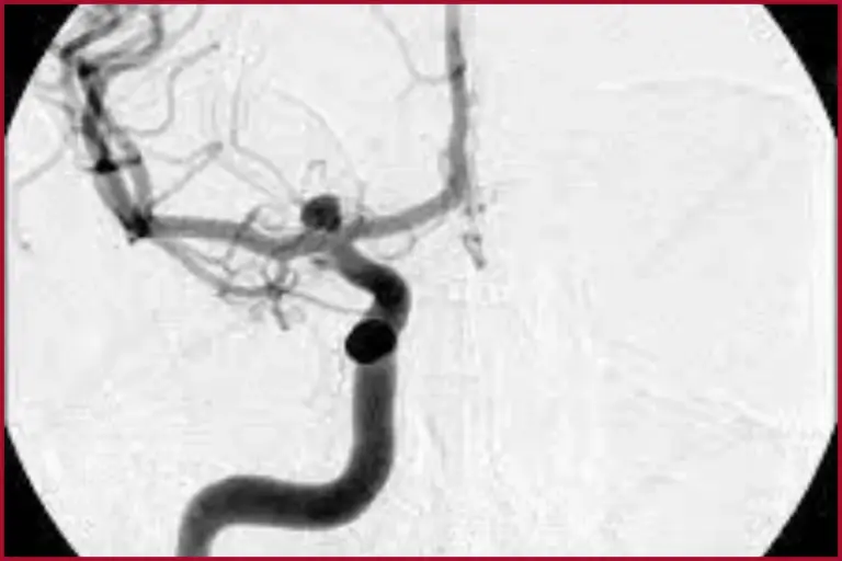 Angiogram: Best CT Accuracy Health Fact