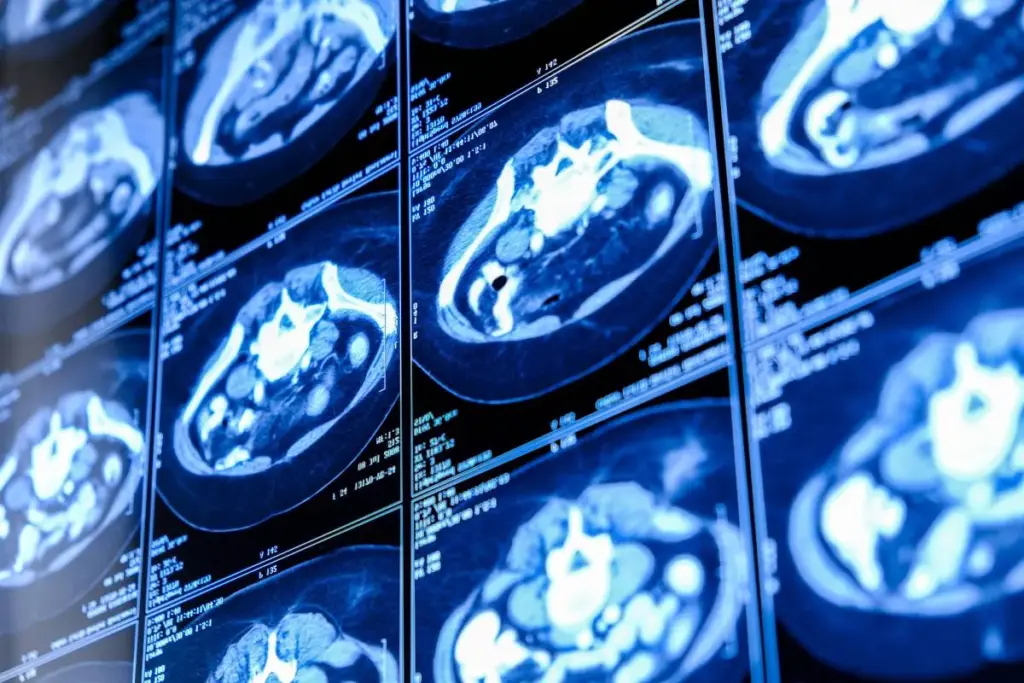 CT Scan: Top Cardiac Disadvantage Facts 1 CT Scan: Top Cardiac Disadvantage Facts