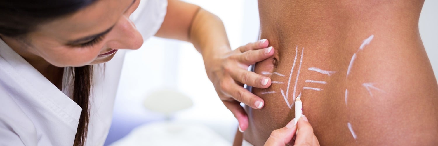 surgeon drawing lines womans abdomen liposuction cellulite removal x banner 1500 500 LIV Hospital