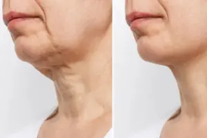 What is Rhytidectomy? A Medical Definition Guide