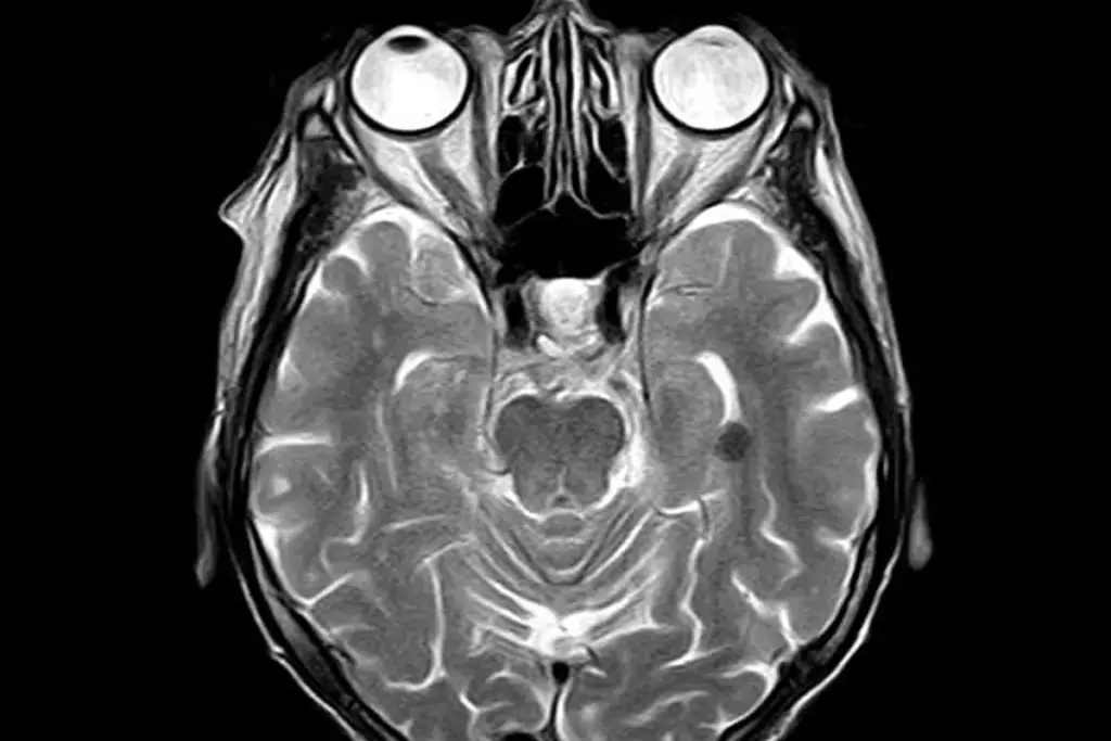 Tinnitus Danger Signs: Best MRI Benefits