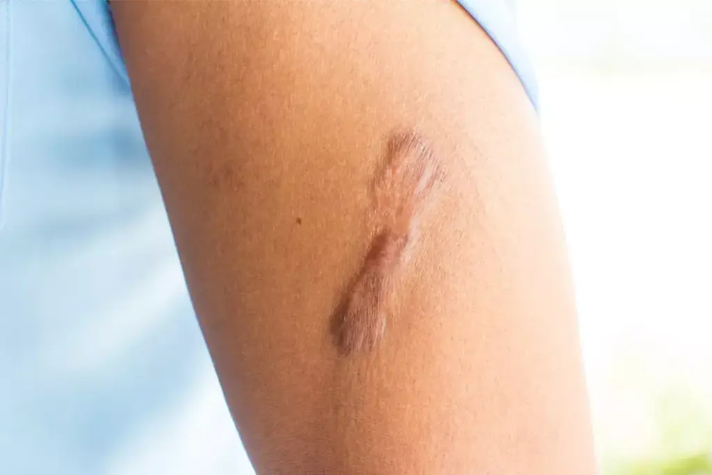 How to Get Rid of Keloids: Complete Treatment Guide 3 How to Get Rid of Keloids: Complete Treatment Guide