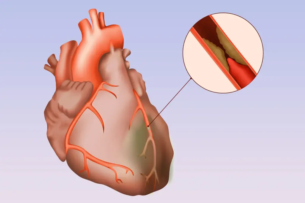 4 Stages Ischemic Heart Disease: Critical Guide