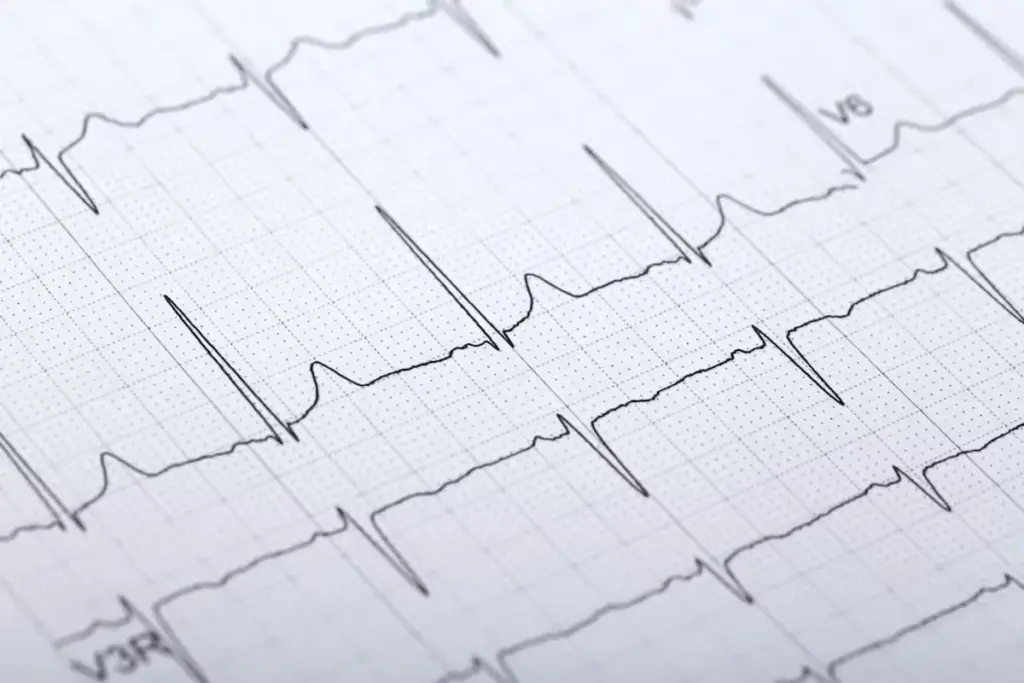 EKG Ischemia Detection: What You Must Know