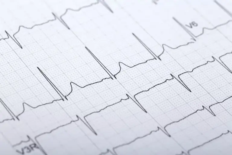 EKG Ischemia Detection: What You Must Know
