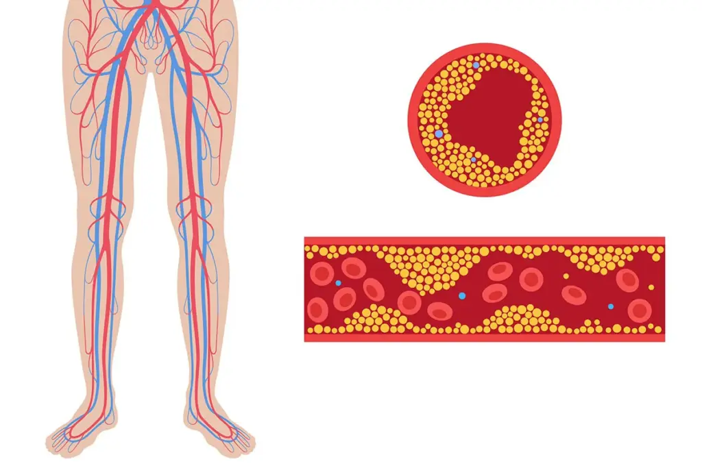 Reverse Peripheral Arterial Disease: Key Steps 1 image 1 1190 LIV Hospital