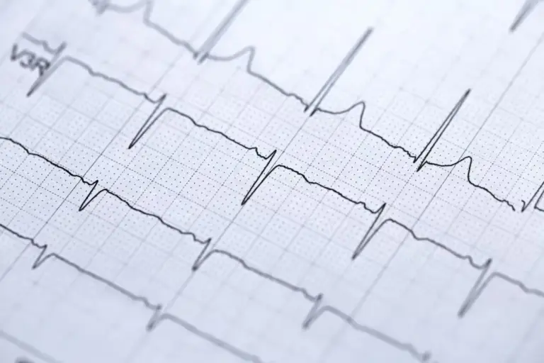 Critical Atrial Fibrillation Concerning Symptoms