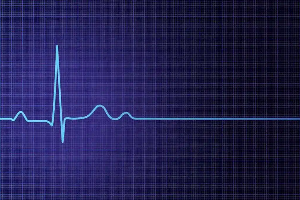 atrial fibrillation episode positioning