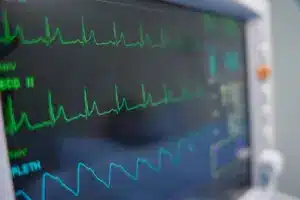 Key Atrial Fibrillation Primary Triggers