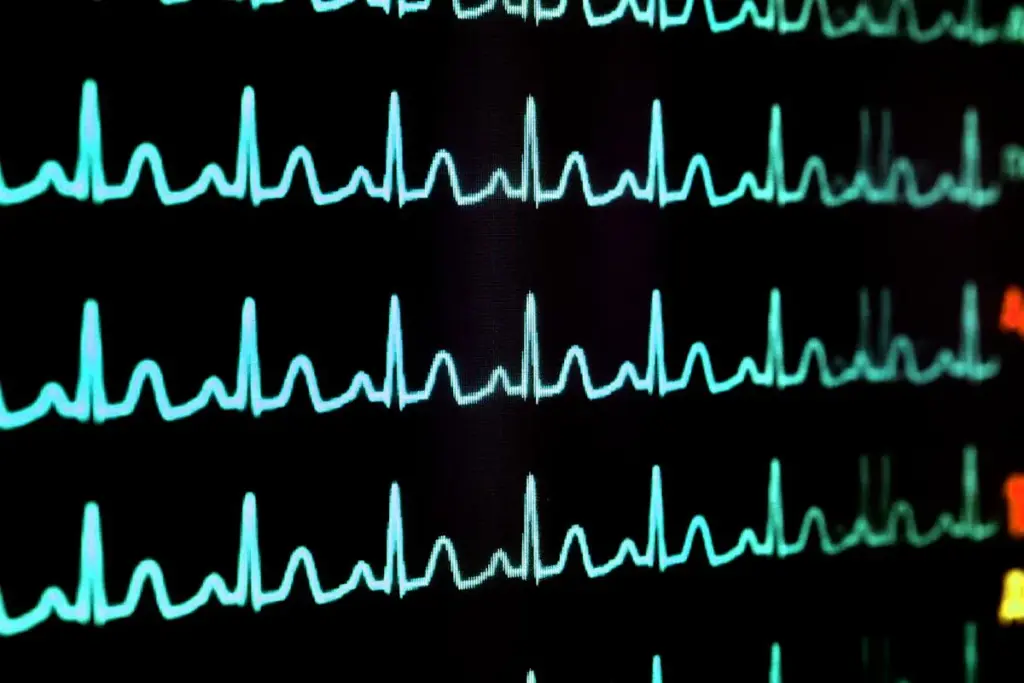 Warning: Fatal Arrhythmia Sudden Cardiac Death