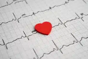 Key Arrhythmia Life Expectancy Impact Assessment