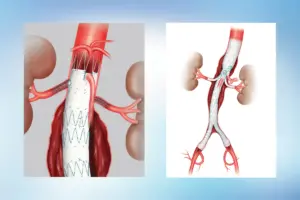 How To Shrink An Aortic Aneurysm Naturally: The Amazing Truth