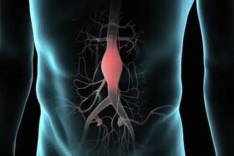 Thoracic Aortic Aneurysm Symptoms: Crucial Most Common Complaint