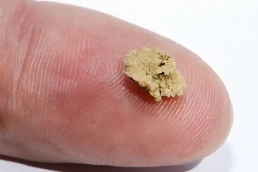 Amazing What Is Inside A Wart: Genital Warts Explained