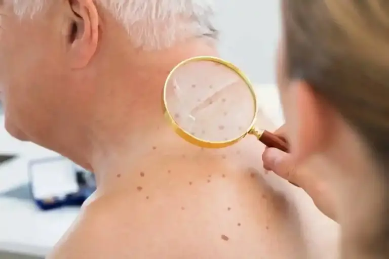 Guide What Age Does Melanoma Peak: Skin Cancer Statistics