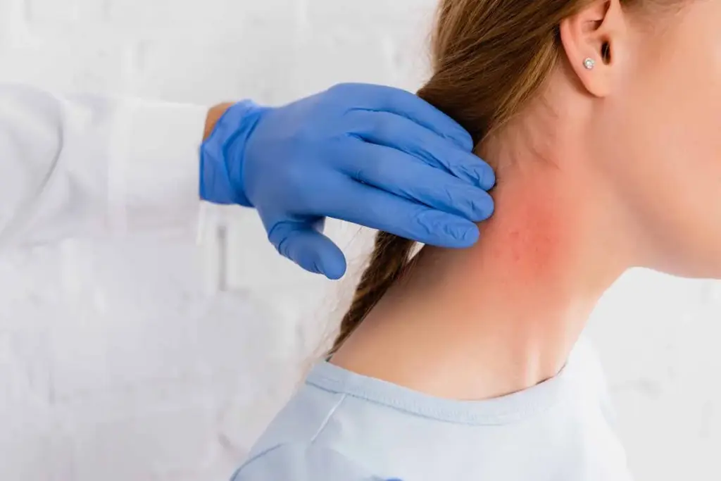 Complete What Is The True Patch Test For Allergies? 3 image 3 771 LIV Hospital