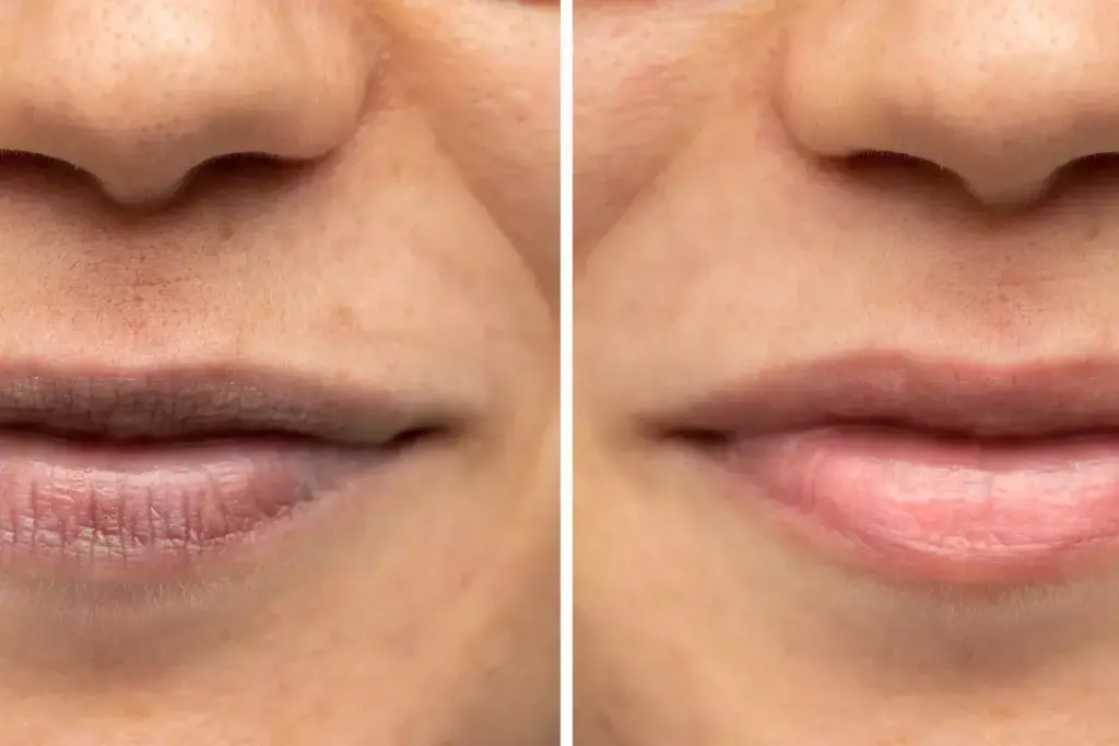 How to Avoid Lip Injection Scars: Safe Augmentation Guide