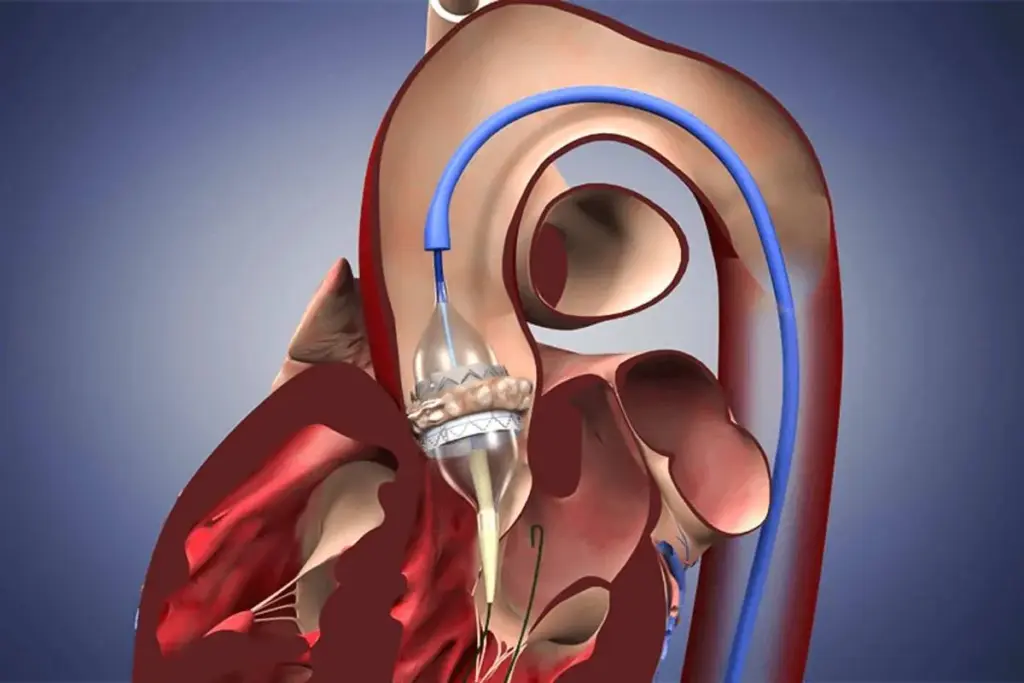 Aortic Valve Replacement Hospital Stay: Crucial Time Frame