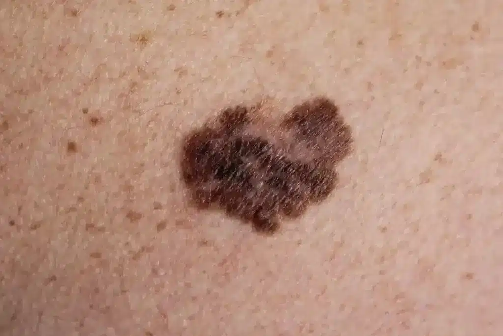 Ultimate 3 Warning Signs A Moles Is Becoming Cancerous