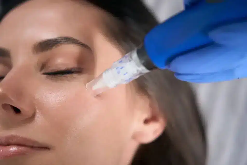 Insightful What Is The Average Microneedling Cost?