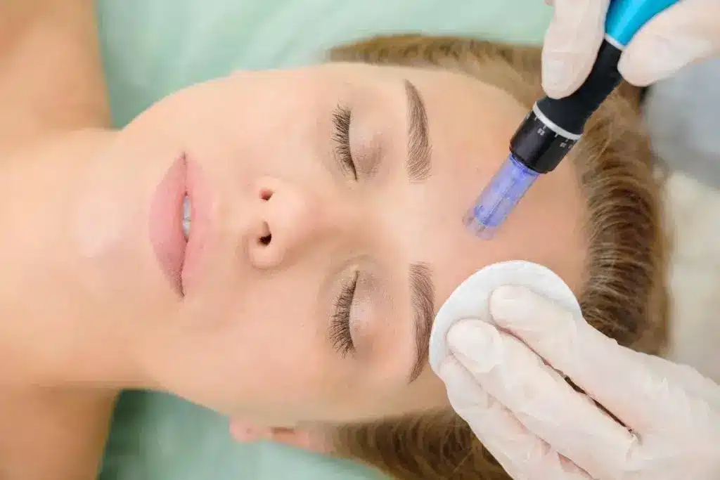 Fascinating What Does Microneedling Actually Do For Your Skin? 3 Fascinating What Does Microneedling Actually Do For Your Skin?
