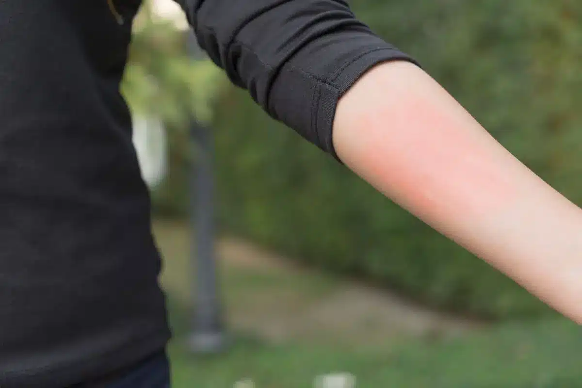 Urticaria: The Crucial Serious Red Flags You Must Know Fact