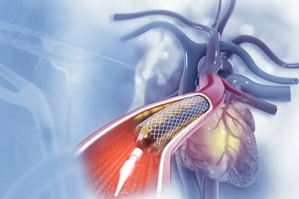 Insightful How Painful Is Angioplasty: Angioplasty Pain Explained