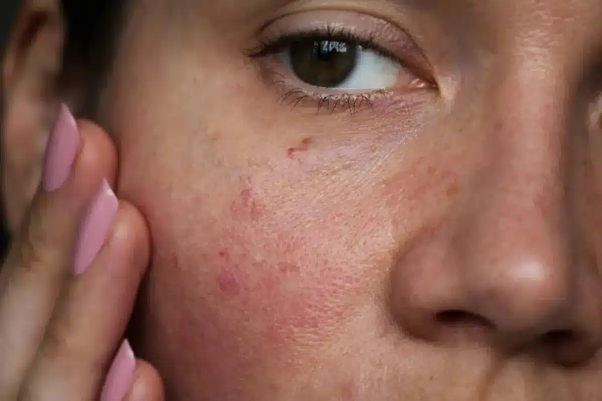 Amazing Why Does Eczema Lighten Skin (Pigmentation Changes)?