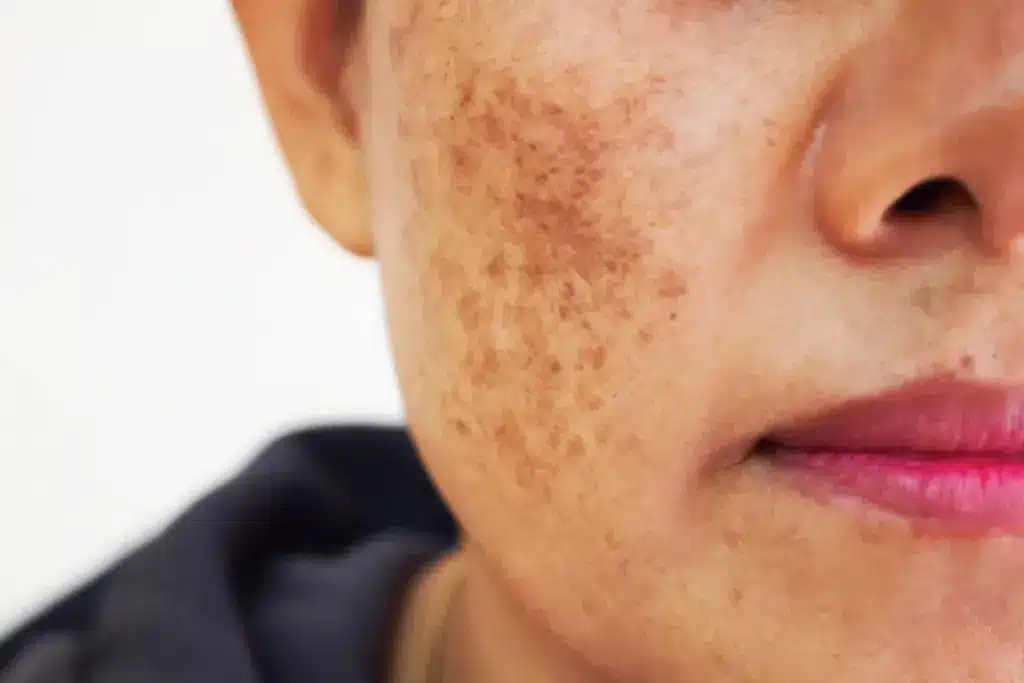 Amazing Does A Chemical Peel To Remove Tan?