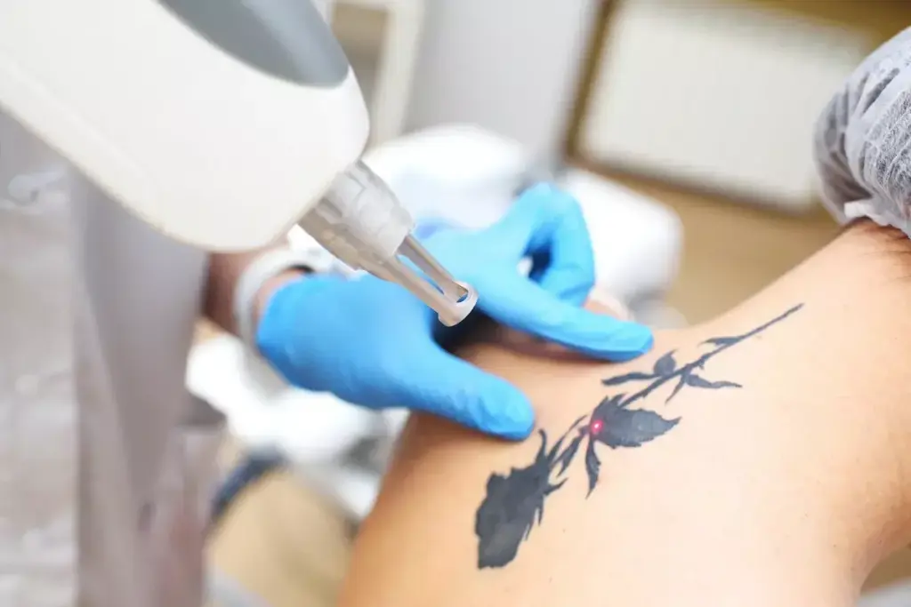 How to Remove Tattoos with Microdermabrasion