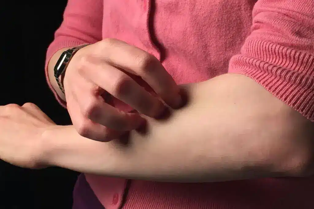 Antihistamine Hives Rash: Crucial Powerful Instant Relief Tips