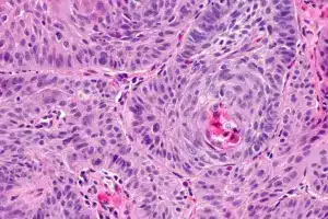 Pictures: 7 Clear Signs of What Squamous Cell Carcinoma Looks Like