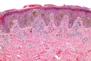 Fascinating Is Melanoma Curable If Caught Early?