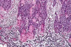 pictures: Fascinating What Color Are Cancerous Spots (Pictures)?