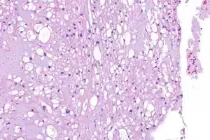 Simple How Many Years Does It Take For SCC Skin Cancer To Spread?