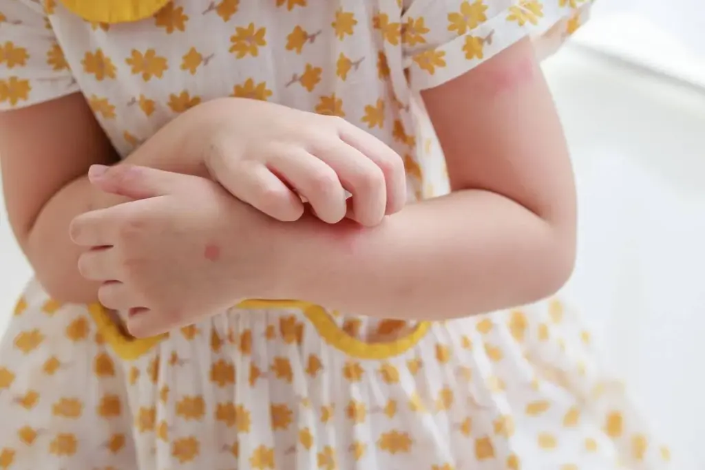 Antihistamine Hives Rash: Crucial Powerful Calming Tips