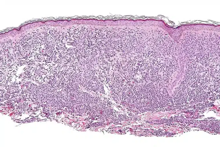 Sharp How Deep Does A Skin Biopsy Go (Bypsee)?