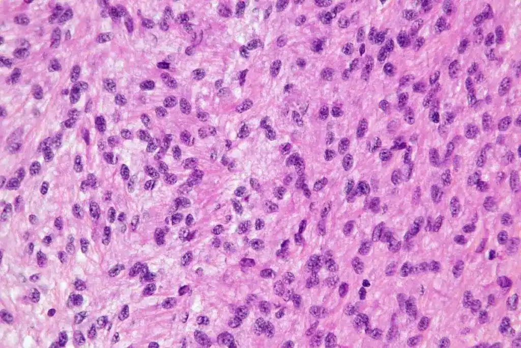 New Squamous Cell Carcinoma Treatment Options 1 New Squamous Cell Carcinoma Treatment Options