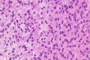 New Squamous Cell Carcinoma Treatment Options