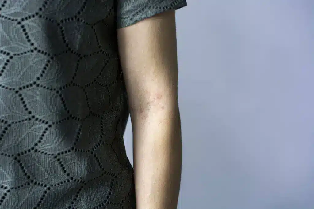 Skin Conditions: Crucial Disability Fact About Chronic Urticaria