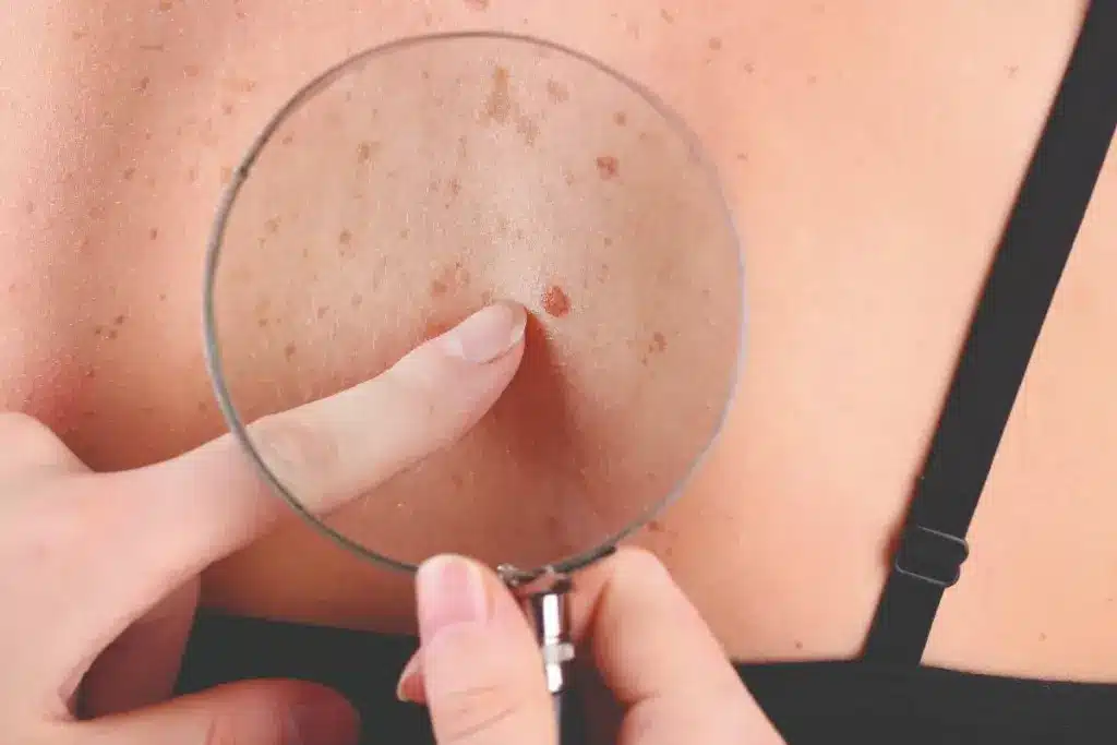 Sharp What Shouldn't A Mole Look Like (Malignant Signs)?