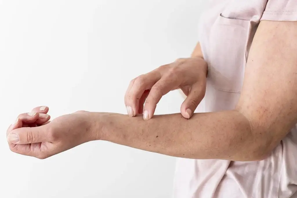 Hives After Virus: Crucial Powerful Post-Infection Fact