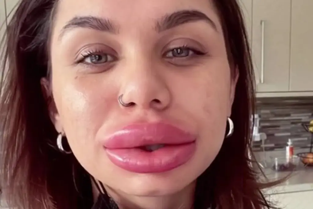 Essential What's The Longest Botox Will Last: Guide