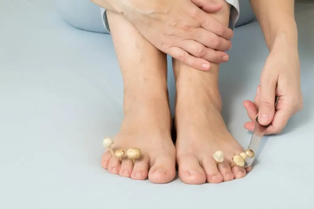 Complete What Is A Fungal Infection Under The Feet (Athlete's Foot)?