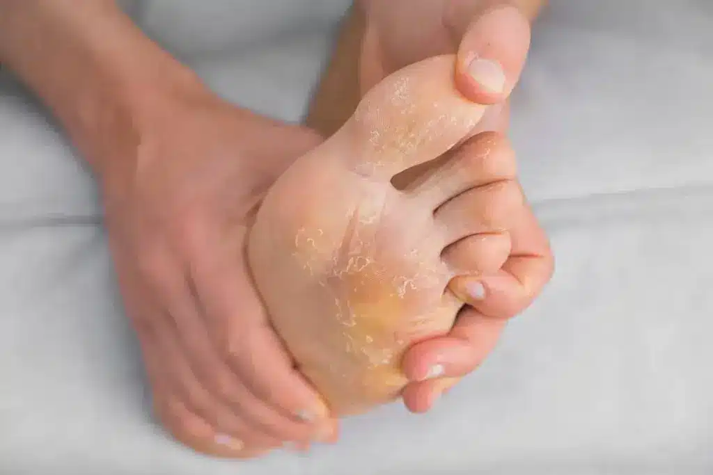 Complete What Is A Fungal Infection Under The Feet (Athlete's Foot)?