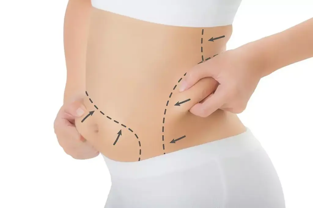 How to Achieve Immediate Fat Loss With Non-Surgical Body Sculpting