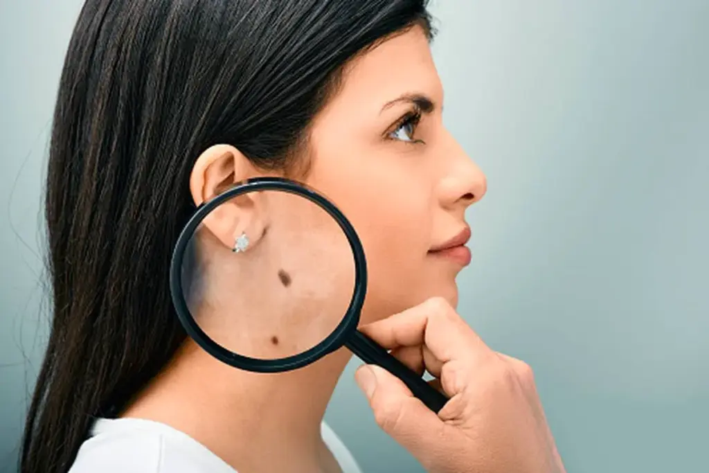 Amazing How Can You Identify A Cancerous Mole (Melanoma)?