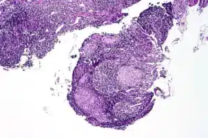 Essential What Conditions Can A Skin Biopsy Show (Biopsy Explained)?