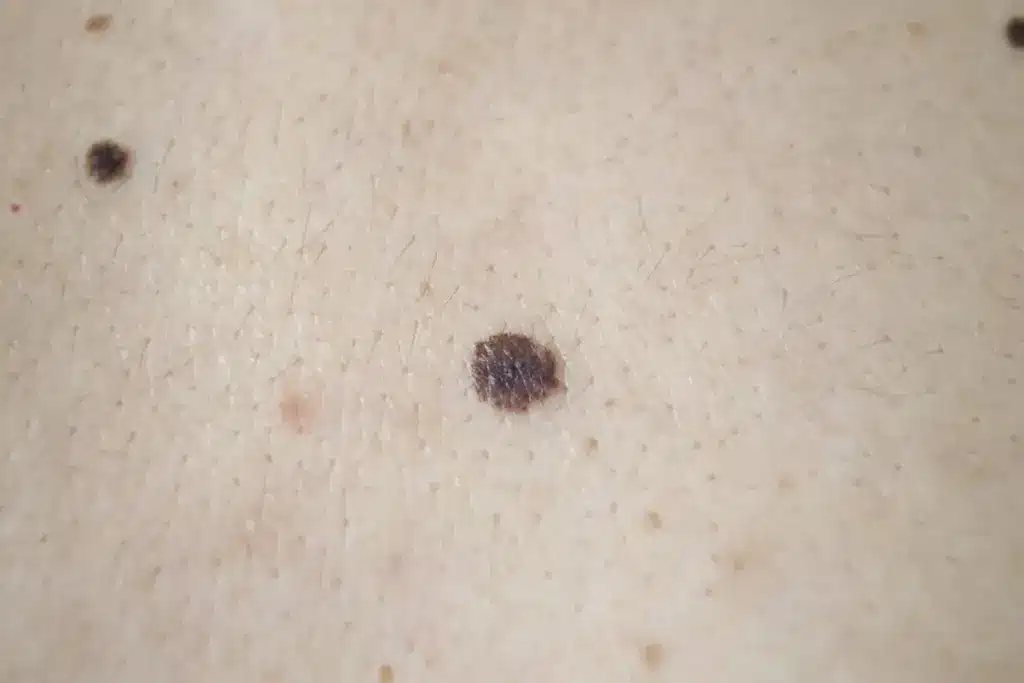 Essential How To Tell If A Spot Is Cancerous (Black Dots On Skin)