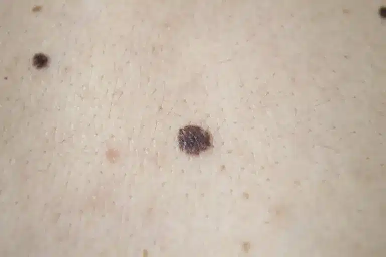 Essential How To Tell If A Spot Is Cancerous (Black Dots On Skin)